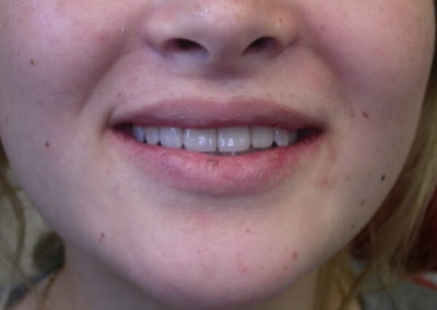 Before and After – Invisalign treatment