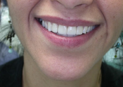 Before and After – Veneers/Inlays/ Onlays